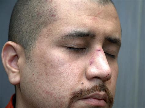 George Zimmermans Injuries Photo 1 Pictures Cbs News