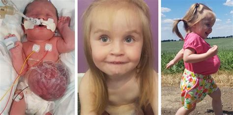 Meet The Little Girl Who Was Born Inside Out Real Fix