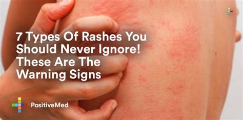 Trustcare The Most Common Types Of Skin Rashes Treatm