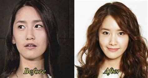 Snsd Tiffany Before And After Surgery