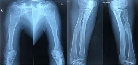 Radiograph Of The Long Bones Of The Upper Limbs Show Evidence Of