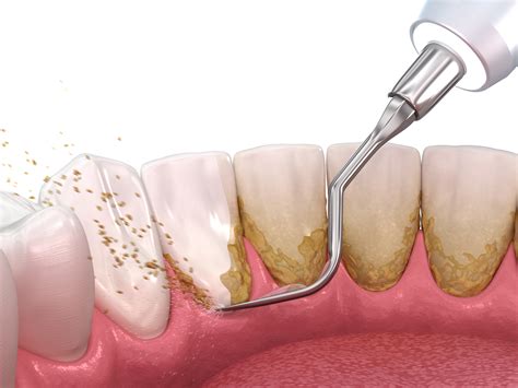 How Dental Scaling Root Planing Help Prevent Gum Disease