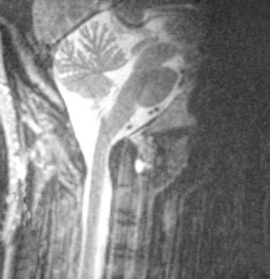 Atlas Fractures Transverse Ligament Injuries Spine Orthobullets