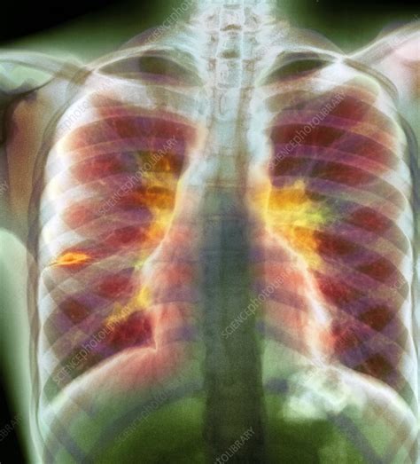 Tuberculosis Lymphadenopathy X Ray Stock Image C0072678 Science