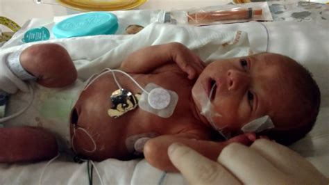 Micro Preemie Born At 31 Weeks Youtube
