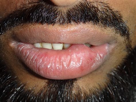 Soft Fluctuant Swelling On Lower Lip Extra Oral View Download Scientific Diagram