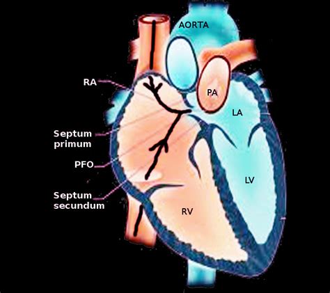 Anatomy Thorax Heart Fossa Ovalis Statpearls Ncbi Bookshelf
