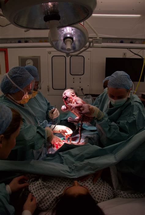 What is a cesarean section? Caesarean section - Wikipedia