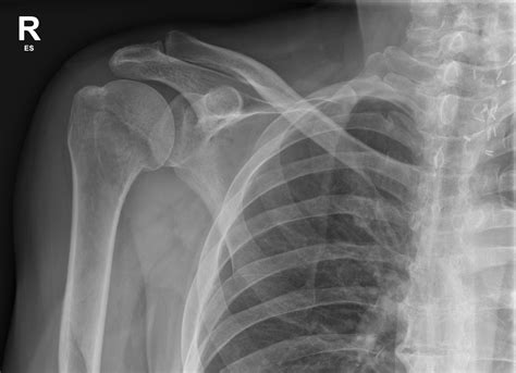 Anatomical Neck Of Humerus Fracture Image Radiopaedia Org