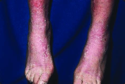 Moderate Hyperkeratosis And Blisters Leading To Erosions In An Adult