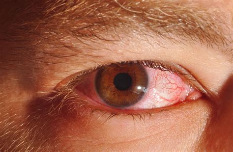 Eye Herpes Symptoms And Treatment