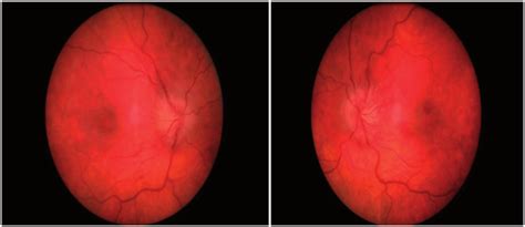 Bilateral Optic Disc Swelling And Retinal Haemorrhages Note Figure 1