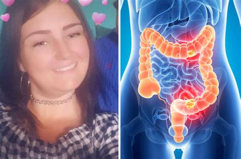 woman dies after doctors confuse cancer with ibs here are the signs daily star