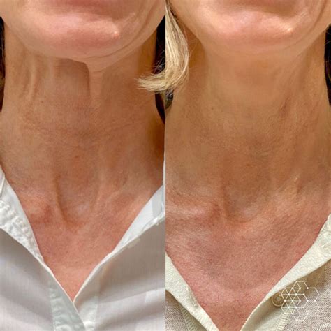 Neck Lines And Laxity Treatments In Vancouver Skin Technique