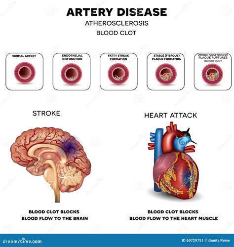 Diferença Entre Aterosclerose E Arteriosclerose Sololearn