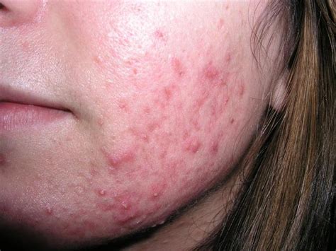 Diseases Of The Sebaceous Glands Acne Inflammatory Of The Face
