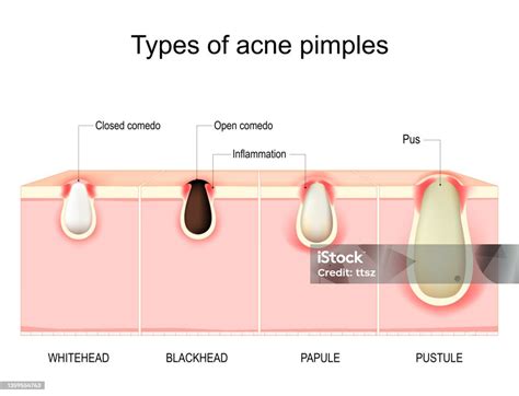 Types Of Acne Pimples Cross Section Of Human Skin Stock Illustration