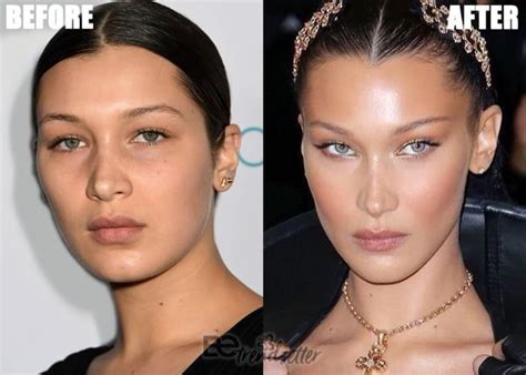 Bella Hadid Plastic Surgery 2019 Botox Brow Lift Eyebrow Lift Eye
