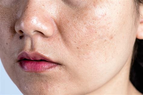 How To Shrink Large Pores And Why They Happen In The First Place