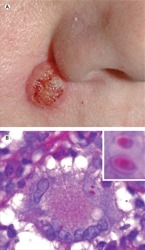 Cutaneous Histoplasmosis The Lancet Infectious Diseases