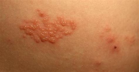 So last week i found out i had gotten hsv1. What are Shingles? Caused by a virus called 'Varicella Zoster', shingles are a kind of a very ...