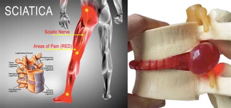 Disc Herniation And Sciatica Explained With A Quick Test
