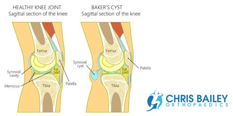 Baker S Cyst Drainage Procedure Best Drain Photos Primagemorg