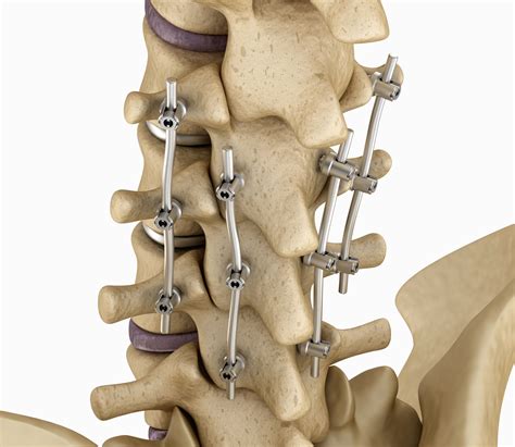 Spinal Fusion Cedar Park Tx Austin Tx Spine Stabilization