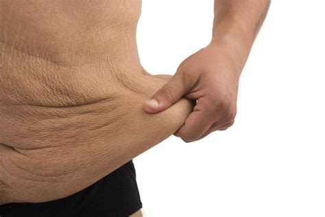 Loose Skin Or Sagging Skin Is A Possible Side Effect Of Weight Loss