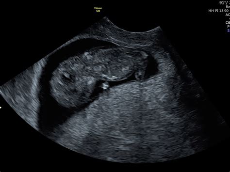 4 Weeks Pregnant Scan 4 Week Ultrasound Babycenter Your Journey