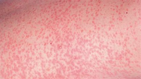 Diagnosis Measles Diagnosis