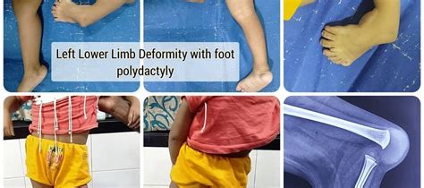 Left Lower Limb Deformity With Foot Polydactyly Waiting For Corrective