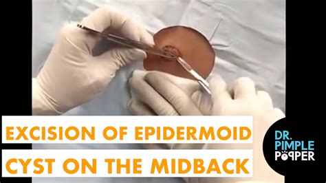 Excision Of An Epidermoid Cyst On The Midback Dr Pimple Popper