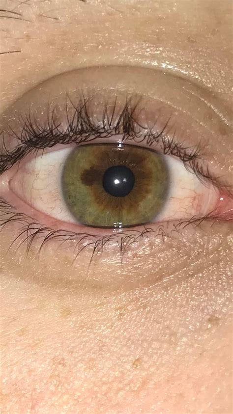My Eye Freckle Eyes
