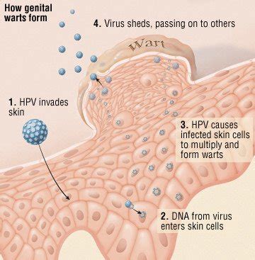 Human Papilloma Virus Hpv Guide Causes Symptoms And Treatment Options