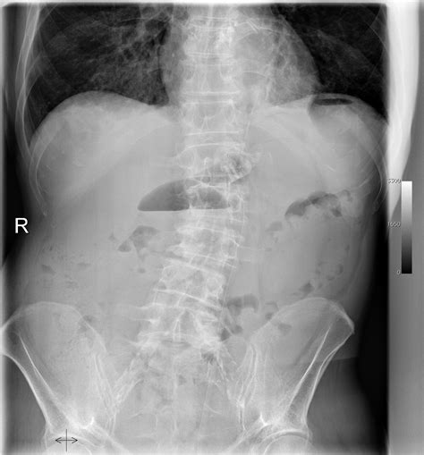 What should i do if i have an ileus? mySurgery | Ileus