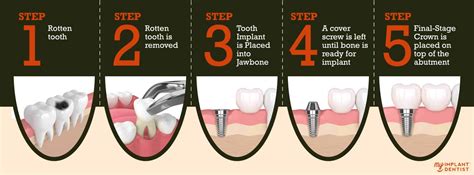 Dental Implant Procedure Step By Step Guide