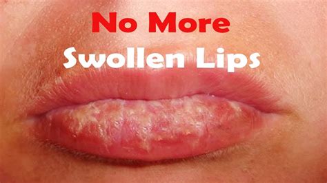 Cure Swollen Lips At Home Use This Simple Remedies Youtube