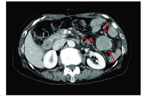 A Ct Scan Shows Progression Of The Residual Lymphadenopathy Three