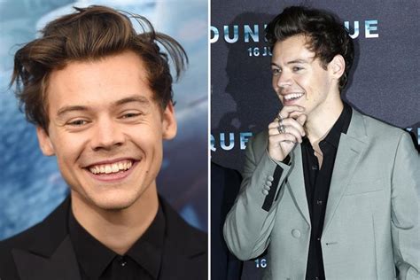 Harry Styles Dimples Are Topping List Of Facial Surgery Wish Lists According To Top Plastic