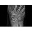Case Study Chronic Right Wrist Pain  Clinical Advisor
