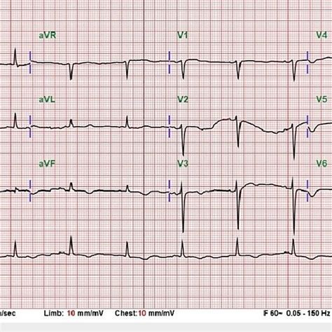Twelve Lead Electrocardiogram At Emergency Department Avr Augmented
