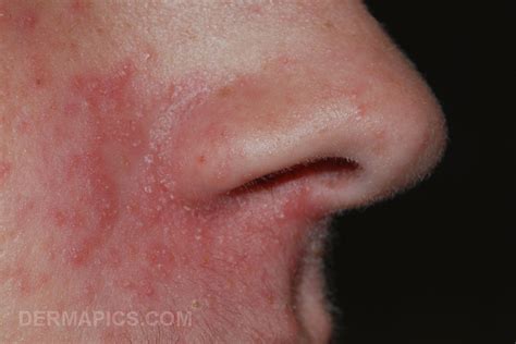 Perioral Dermatitis Nose Pictures Photos