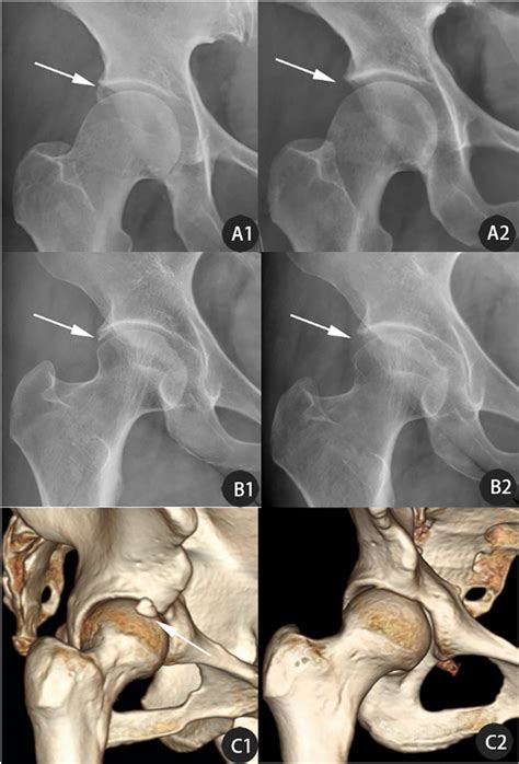Clinical Outcomes Of Hip Arthroscopy For Hip Labrum Calcification In