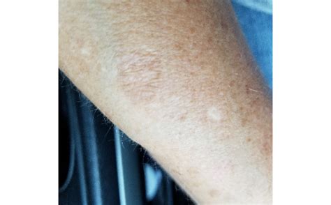Asteatotic Eczema Symptoms Causes And Treatment Tibot
