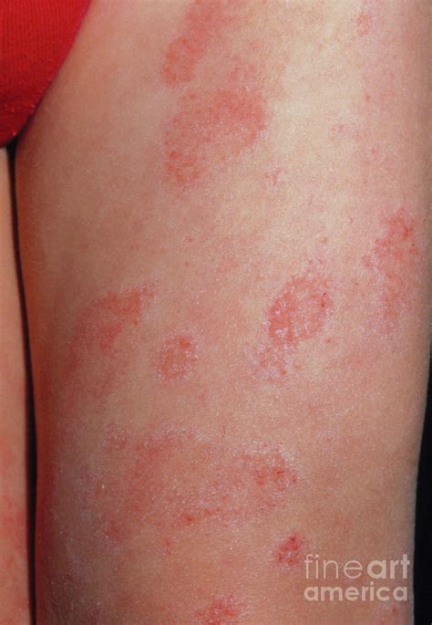 Eczema On Toddlers Legs Pictures