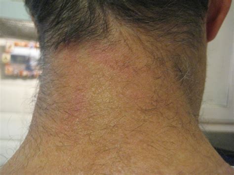 The Gallery For Swollen Lymph Nodes In Back Of Neck