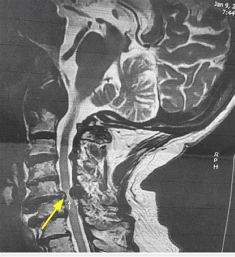 Mri Of The Cervical Spine Axial Showing Cervical Stenosis Done Two