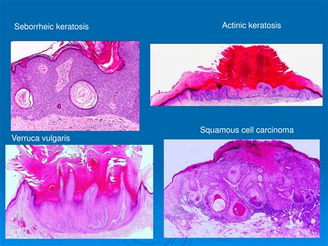 Guide To Microscopic Diagnosis Of Seborrheic Keratosis Verruca
