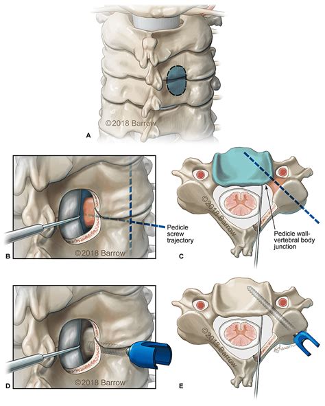 Cureus Technical Feasibility Of Subaxial Cervical Pedicle Screws For